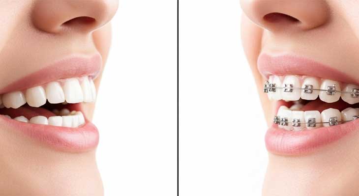 تغییر فرم لب بعد از ارتودنسی