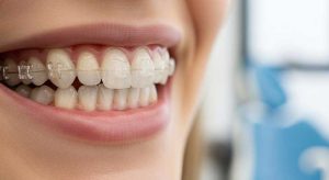 ارتودنسی یک فک