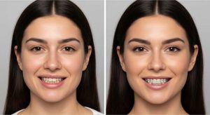 تغییر فرم صورت با ارتودنسی