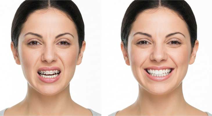 تغییر فرم لب بعد از ارتودنسی