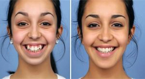 تغییر فرم لب بعد از ارتودنسی