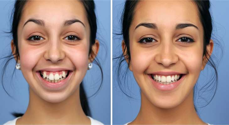 تغییر فرم لب بعد از ارتودنسی