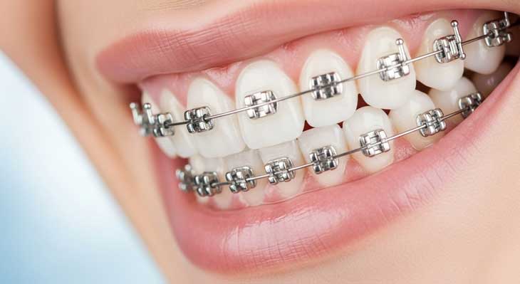 ارتودنسی یک فک