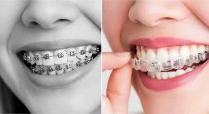 ارتودنسی مجدد