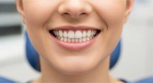 اصلاح خط وسط دندان یا میدلاین