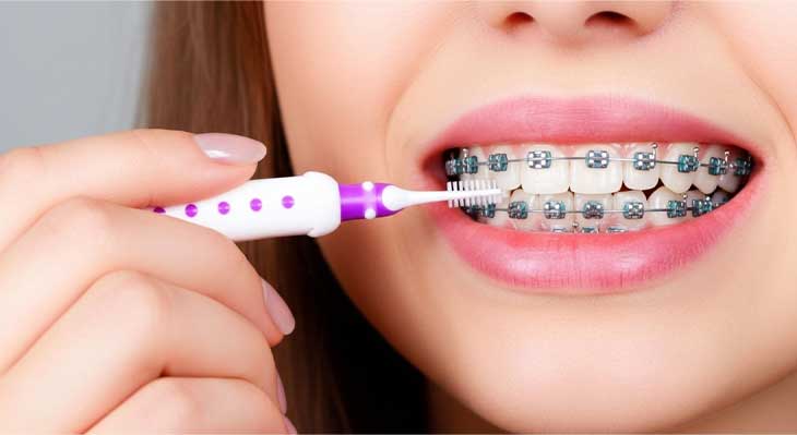 مسواک مخصوص ارتودنسی