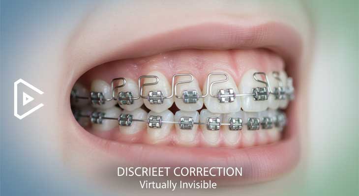 ارتودنسی کاموفلاژ
