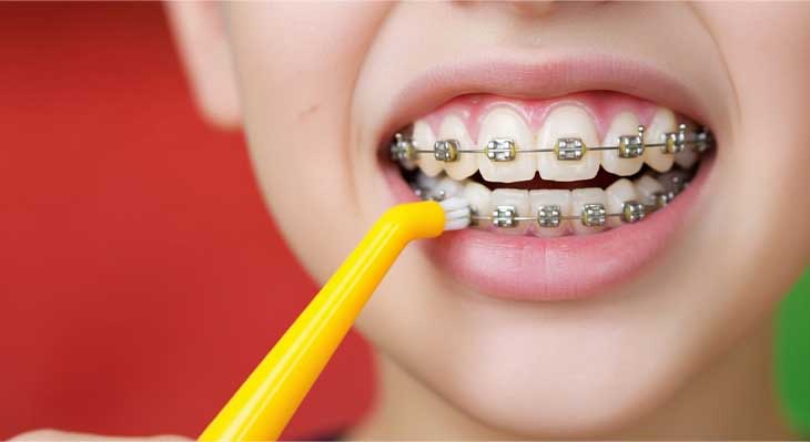 مسواک مخصوص ارتودنسی