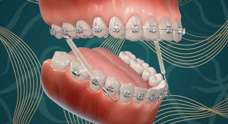 ارتودنسی کاموفلاژ