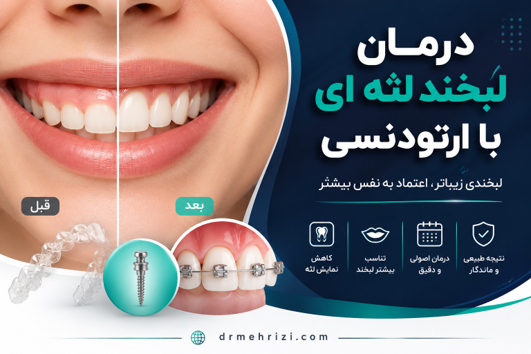 درمان لبخند لثه ای با ارتودنسی