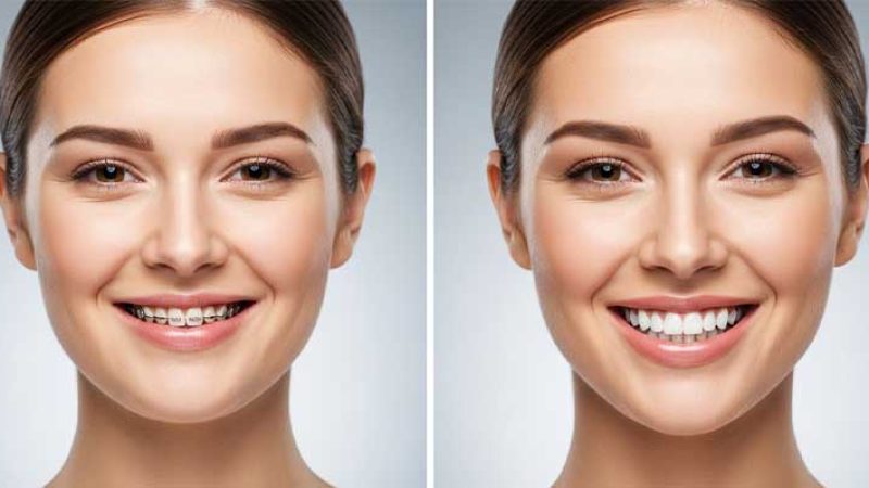 آیا ارتودنسی چهره شما را تغییر می‌دهد؟