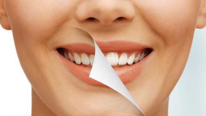 اصلاح طرح لبخند