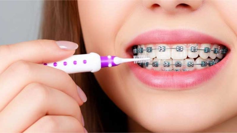 مسواک مخصوص ارتودنسی