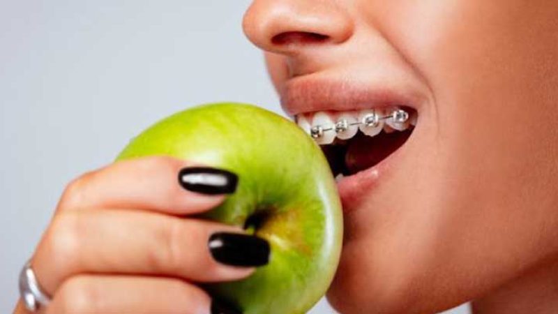 رژیم غذایی در ارتودنسی