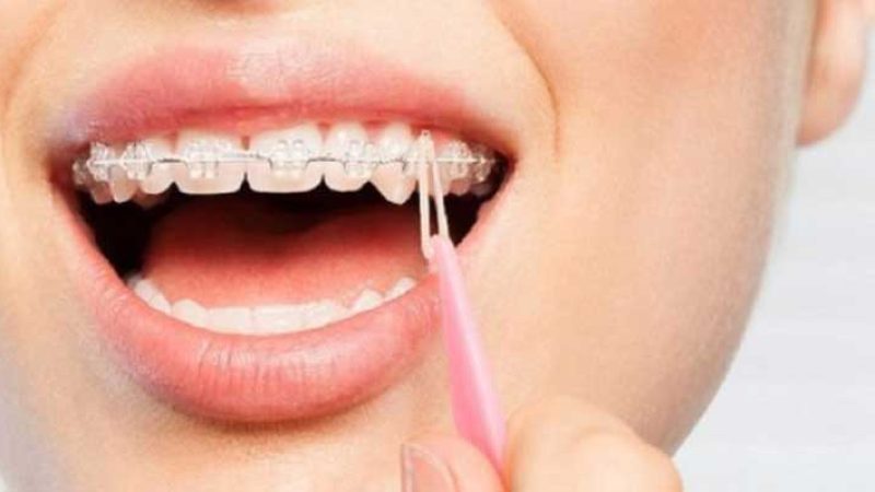 کاهش طول درمان ارتودنسی