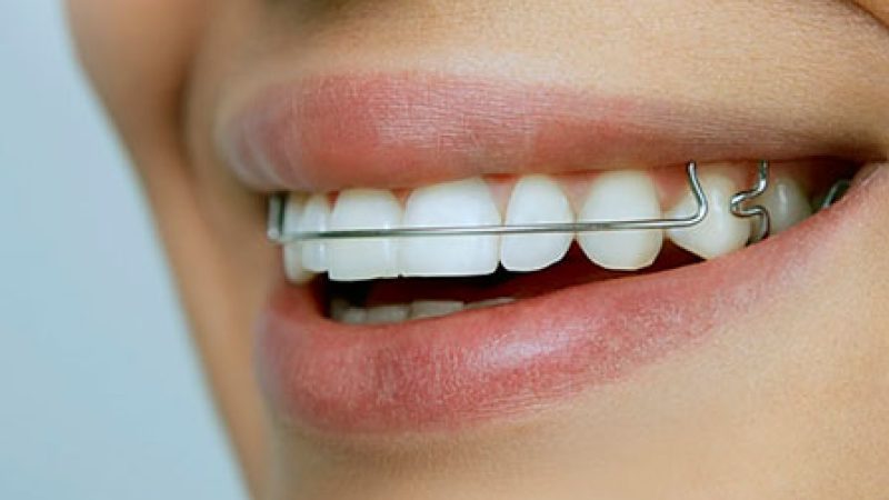 بریس هاولی ارتودنسی متحرک