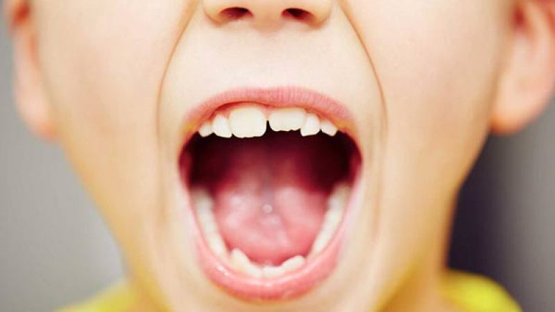 علت کج شدن دندان ها در کودکان