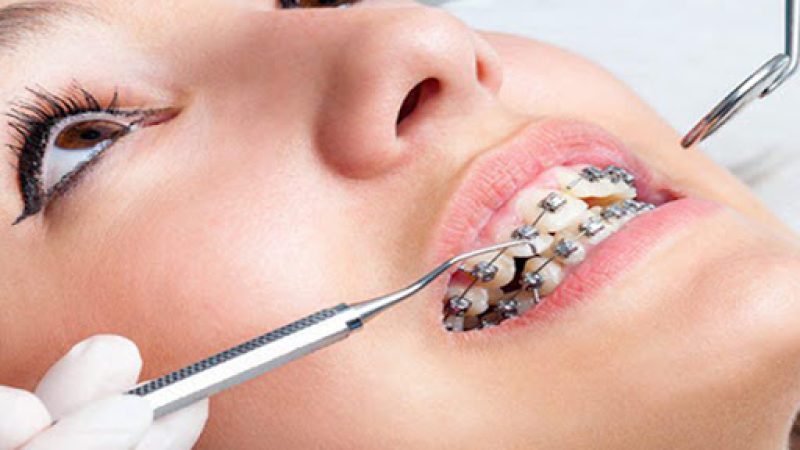 التهاب لثه در ارتودنسی