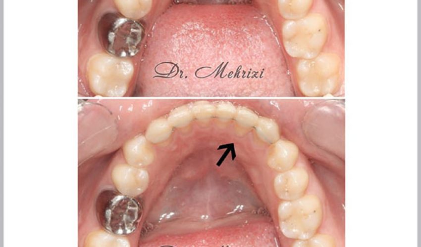 ارتودنسی فک پایین با اینویزالاین