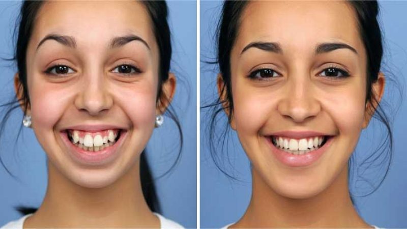 تغییر فرم لب بعد از ارتودنسی