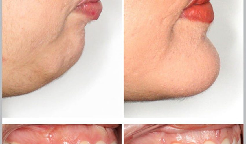ارتودنسی ثابت دو فک همراه جراحی دو فک