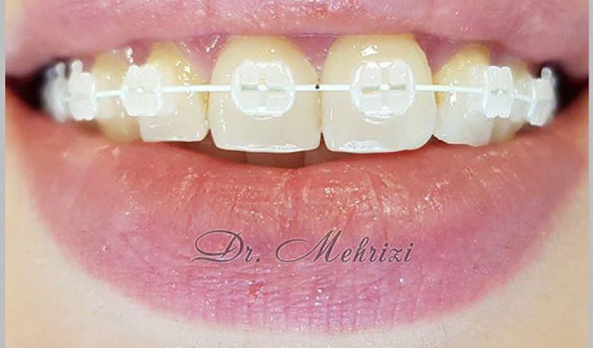  براکتهای سرامیکی با سیم روکشدار