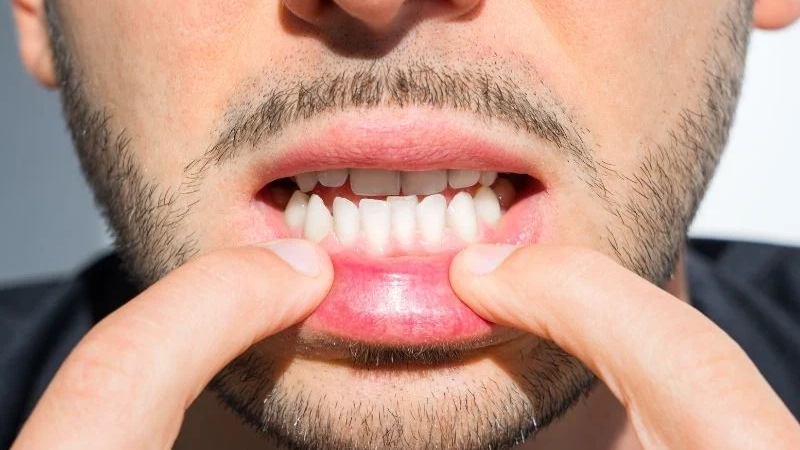 آندربایت چیست