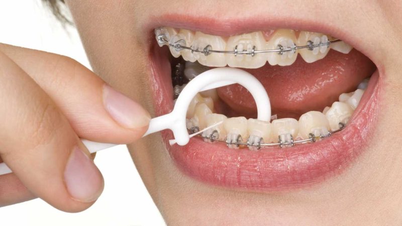 مراقبت های ارتودنسی متحرک