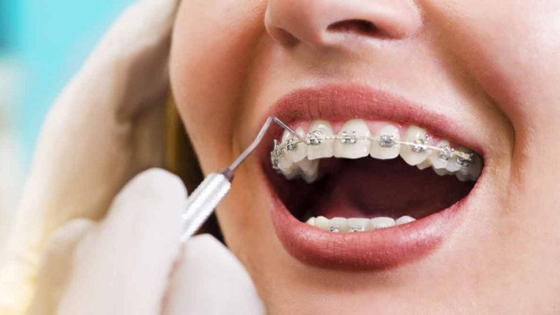 تعداد جلسات ارتودنسی