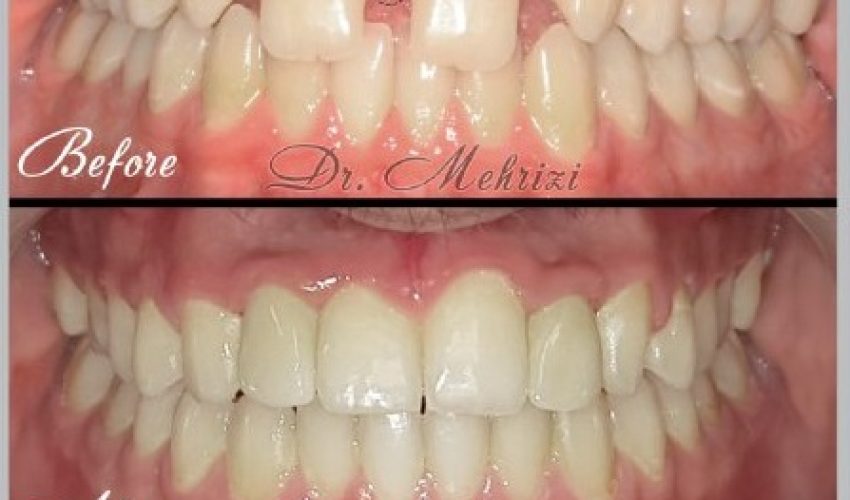 ارتودنسی ایمپلنت روکش
