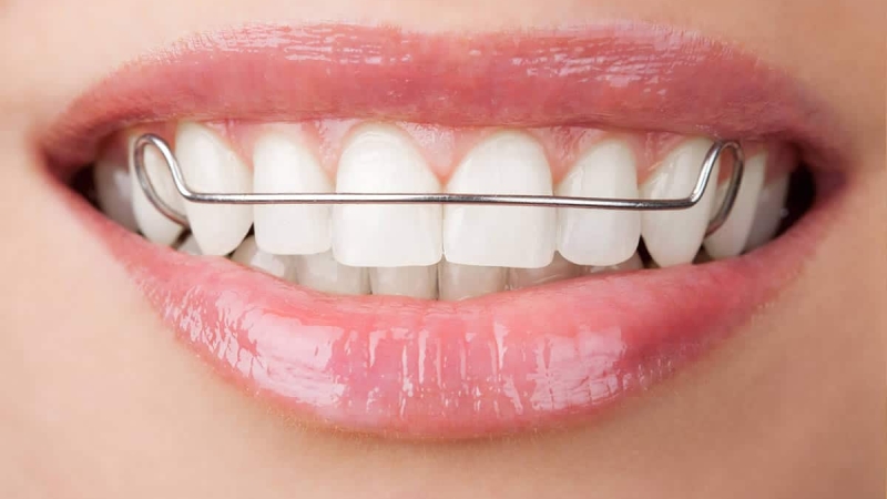 پلاک ارتودنسی چیست؟