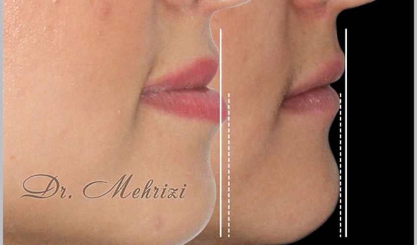 ارتودنسی بدون جراحی فک
