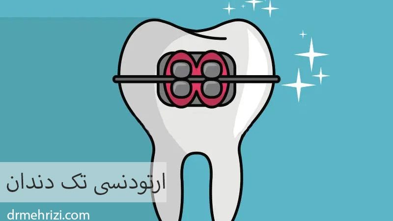 ارتودنسی تک دندان