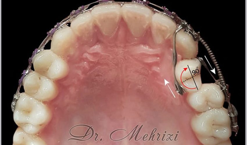 اصلاح چرخش دندانی