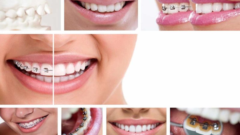 براکت ها چگونه کار می کنند؟