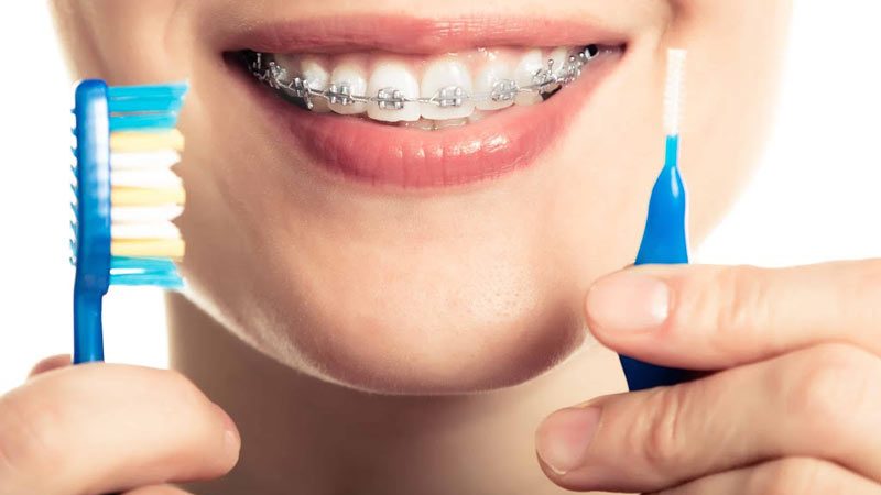 تمیز کردن براکت های ارتودنسی