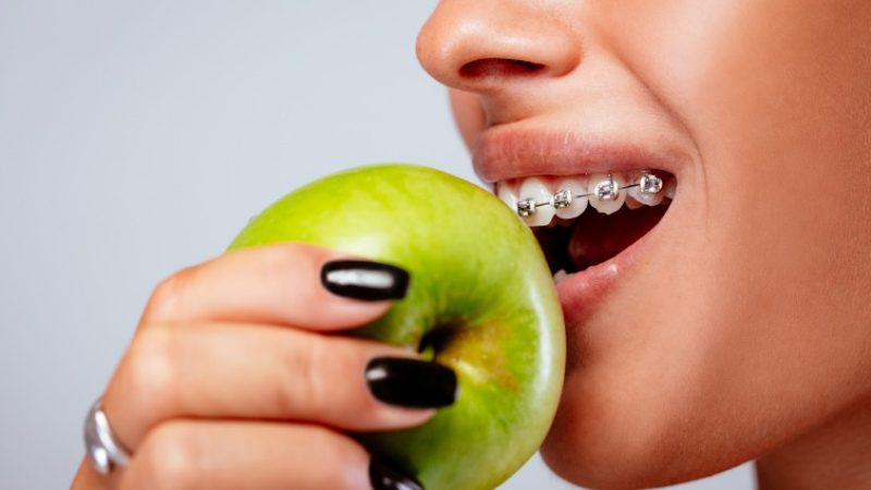 رژیم غذایی در ارتودنسی